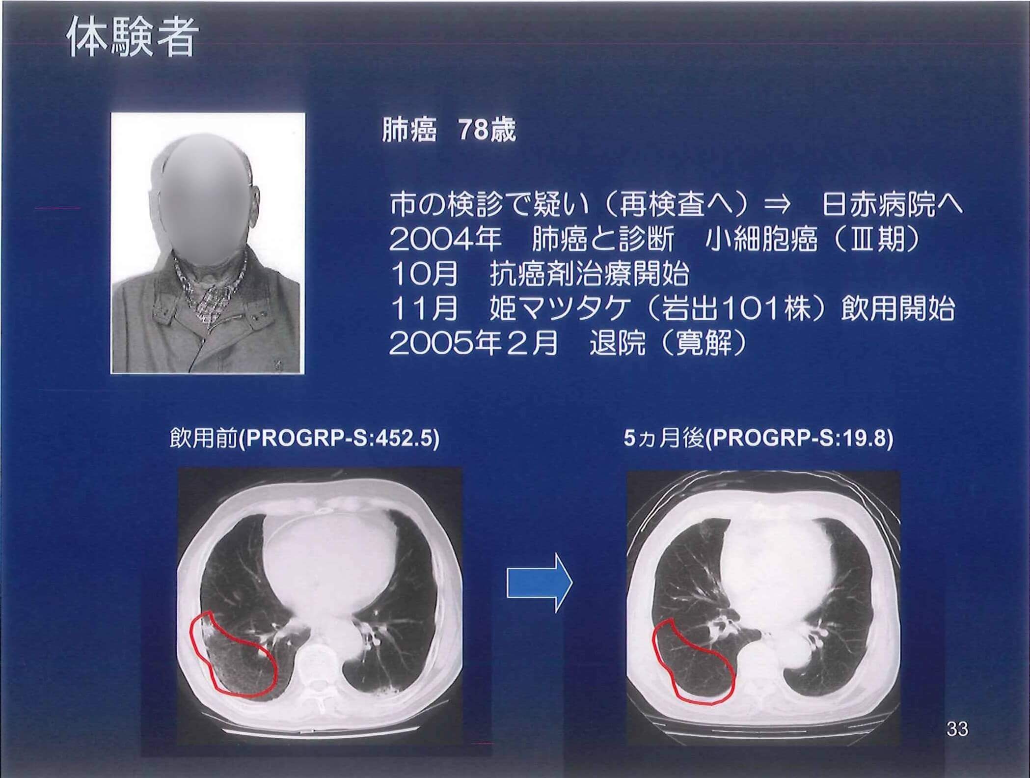 Lung Cancer Patient Feedback